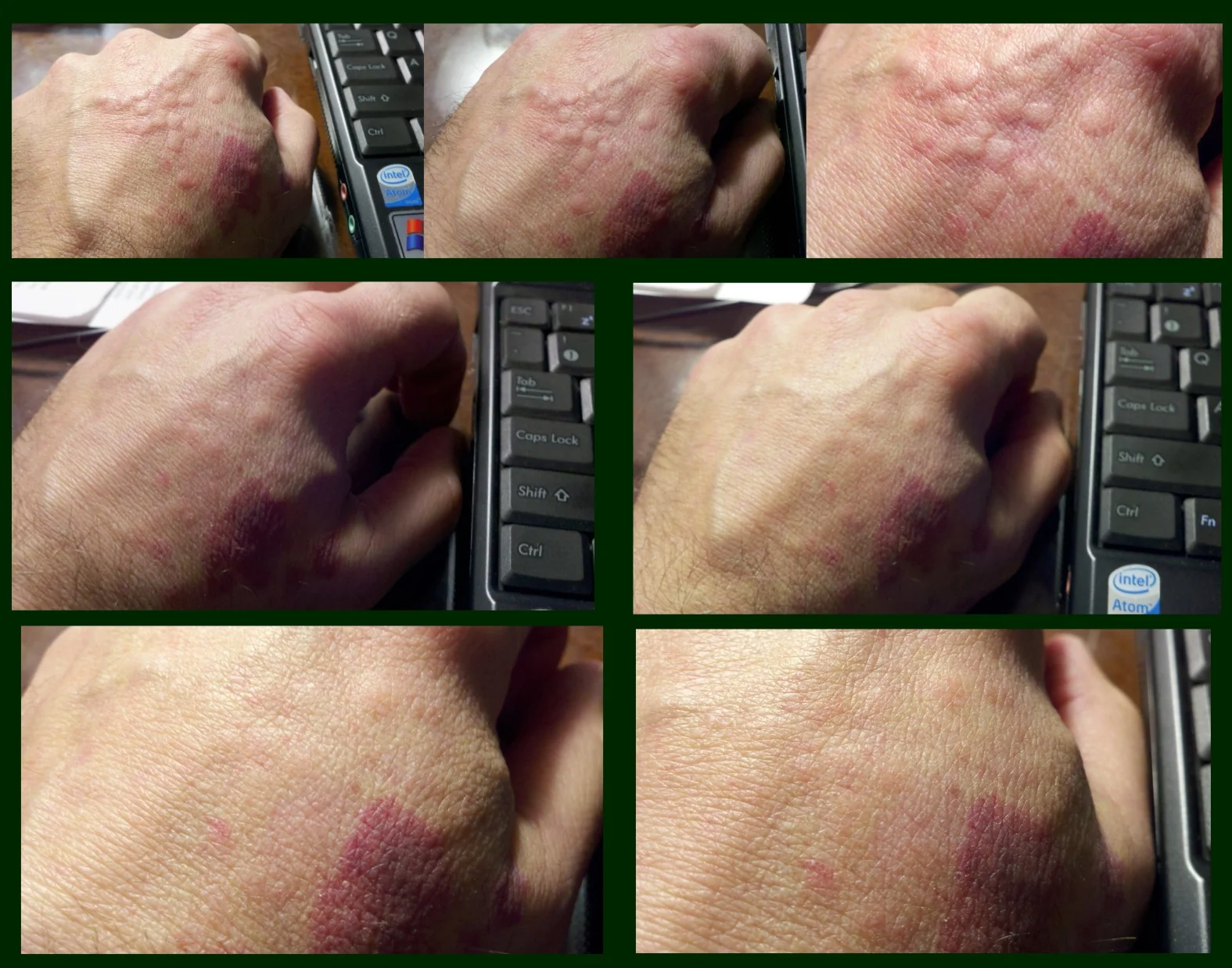 Bite Mark Reaction Over One Hour