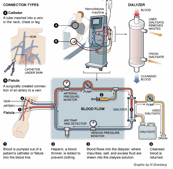 How Dialysis Works.jpg