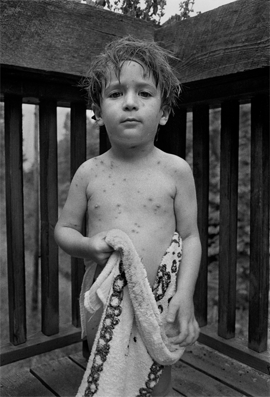 Benny with the Chickenpox, Big Pine, Madison County, NC 1983. I've published this photograph before on this blog, but it remains my favorite image of the ol' boy. Hanging in our bedroom. Yipes.