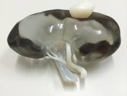 3D model of cancerous kidney courtesy of 3DPrinter.Net