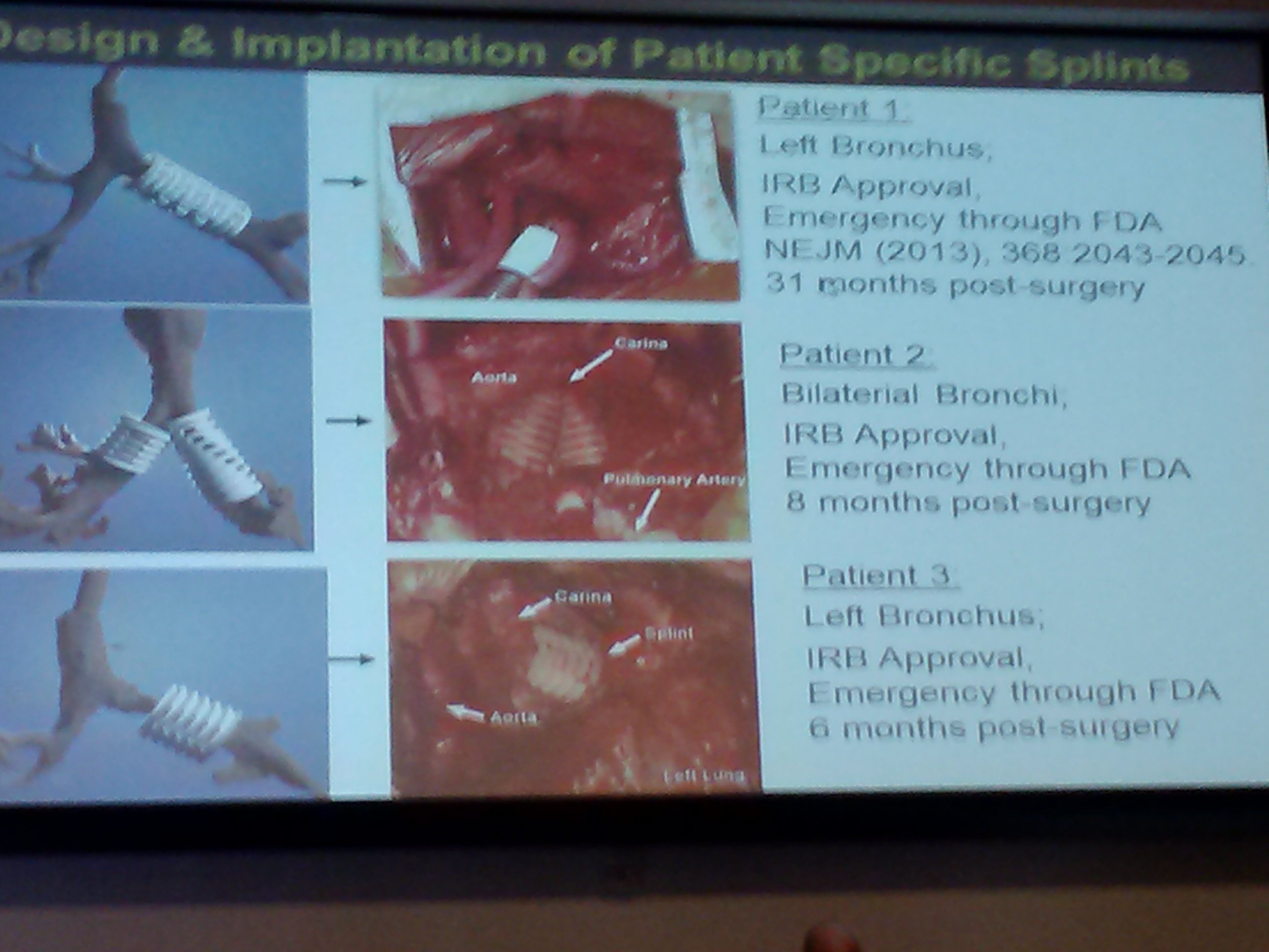 Patient-specific printed splints are used to treat life-threatening thoracic constrictions. &nbsp;Work done at the University of Michigan involves laser sintering bio compatible, bio absorbable materials.&nbsp;
