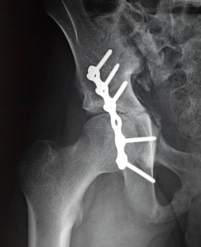 Screws and plate used to repair a hip fracture (image credit 3Dprint.com