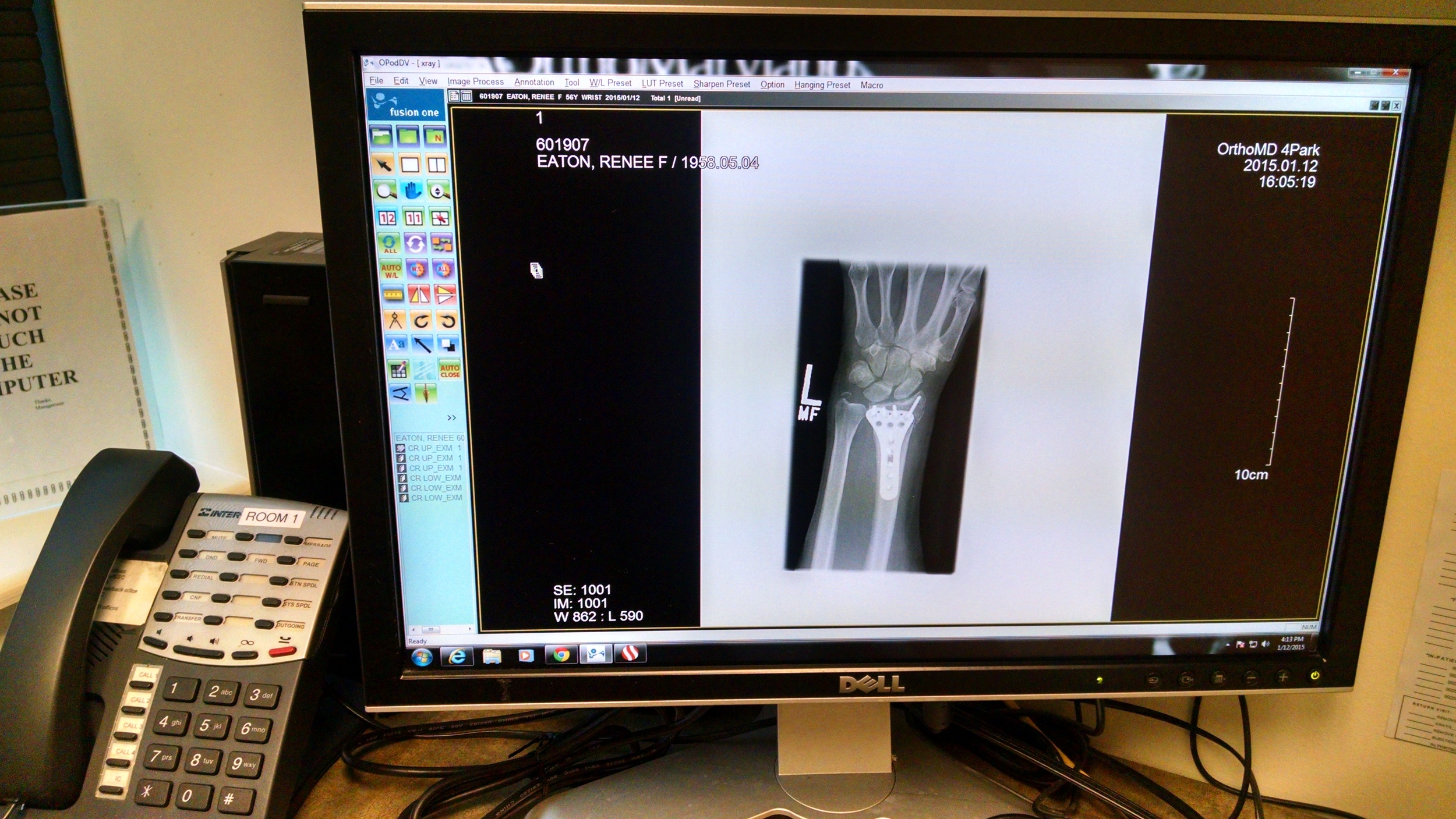 My post-op wrist via traditional Xray image.