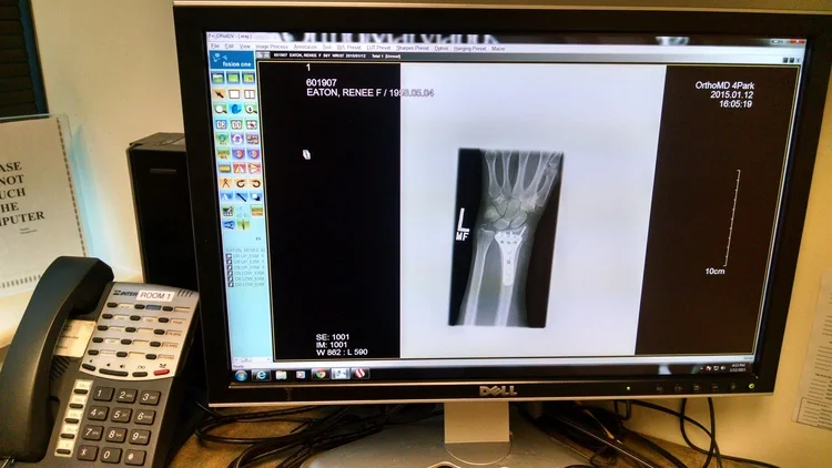 Study confirms value of 3D printed models in planning wrist surgeries