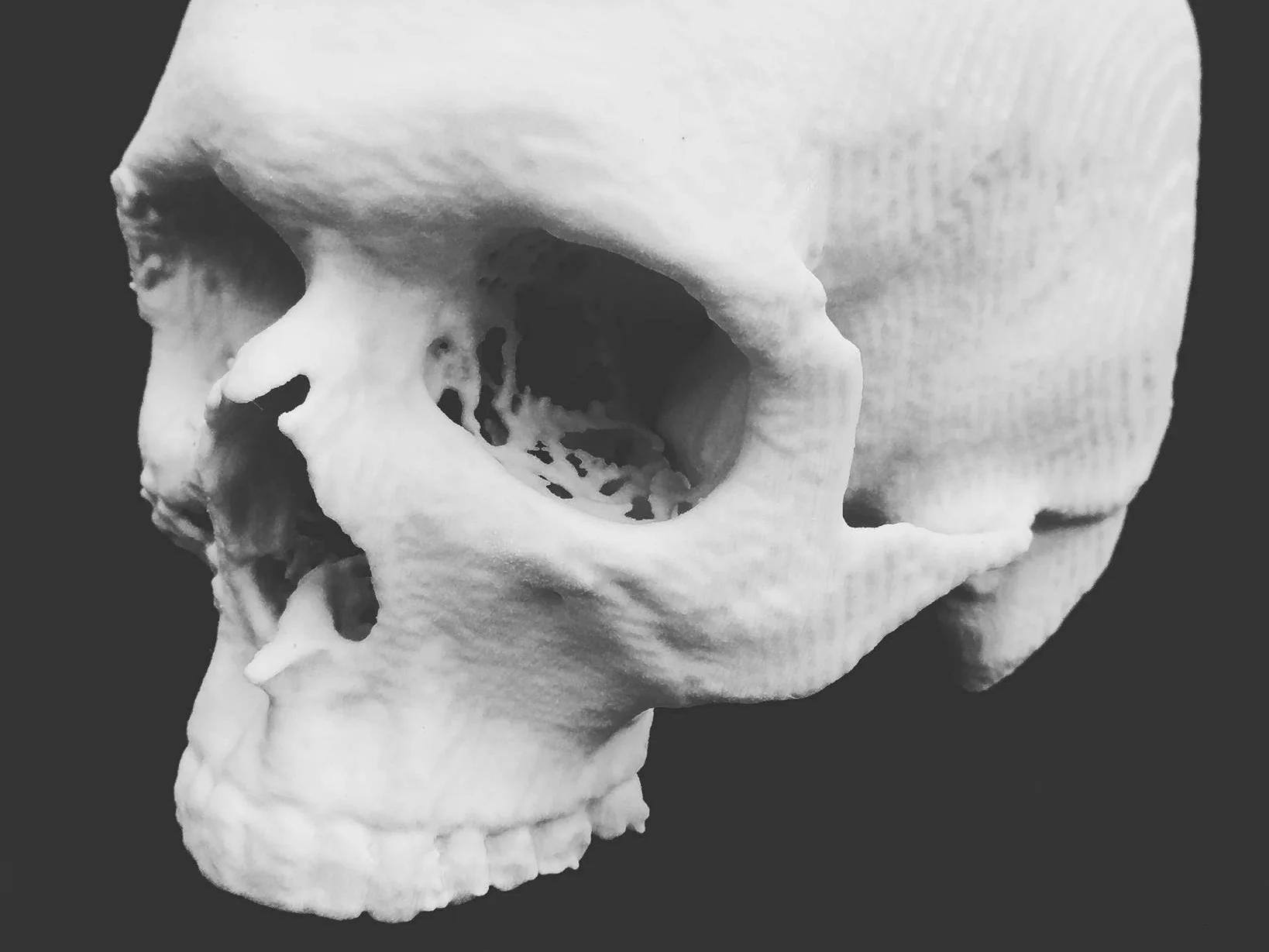 3d-printed-medical-skull