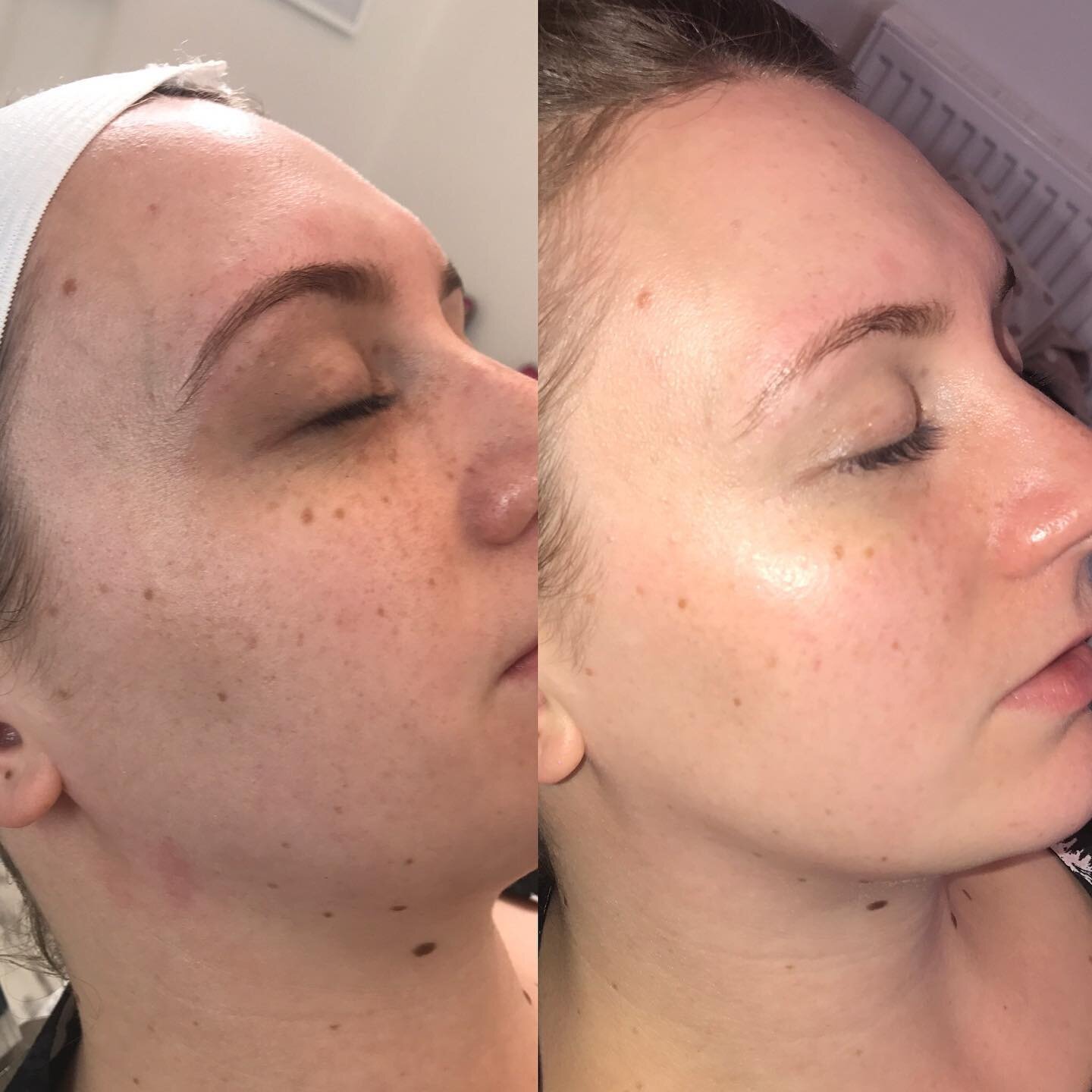 ✨Dermaplaning ✨

DM to book! #dermaplaning #aberdeen #skincare