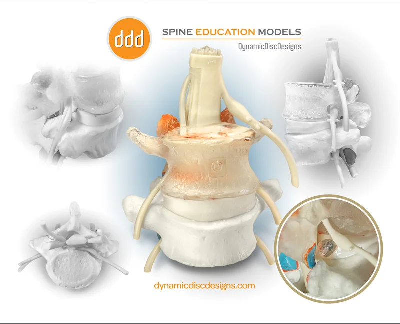 Spine-Education-Models-Dynamic-Disc-Designs-Corp..jpg