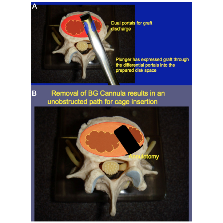Figure 6: Axial view of the prepared disk space during and after application of the bone graft delivery tool. Notes: ( A ) Biportal bone graft delivery tool ejecting bone graft into the prepared area of the disk space. ( B ) Removal of the BG delivery tool leads to an unobstructed path for a fusion cage. Abbreviation: BG, bone graft.