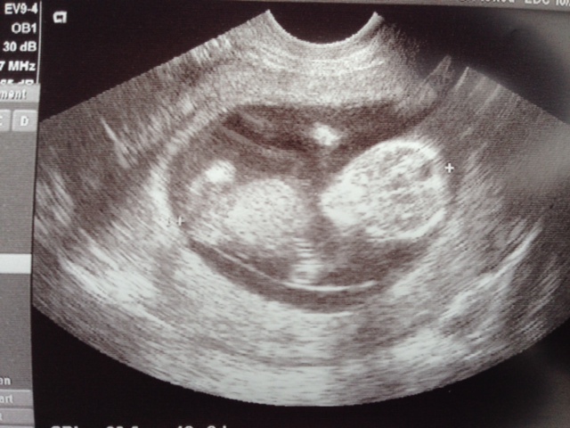 We didn't hear a heartbeat, but seeing this certainly brightened my day! I even shed a tear or two. It's getting a bit more real now...