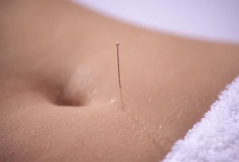 photolibrary_rm_photo_of_acupuncture_on_stomach.jpg