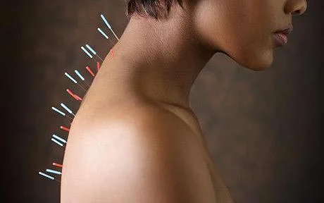 0819-acupuncture_vg.jpg