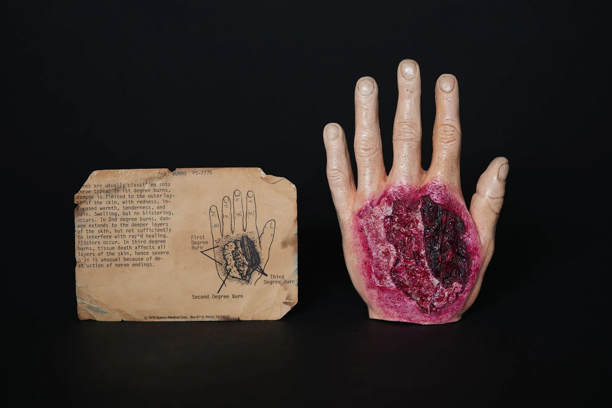 1978 'Burns' Hand Model