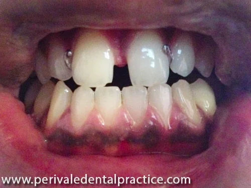 Beginning of cosmetic dental treatment