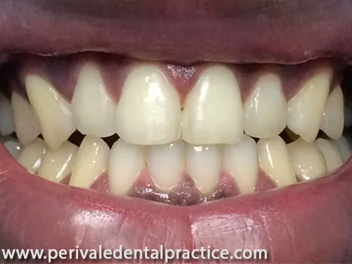 After cosmetic dental treatment