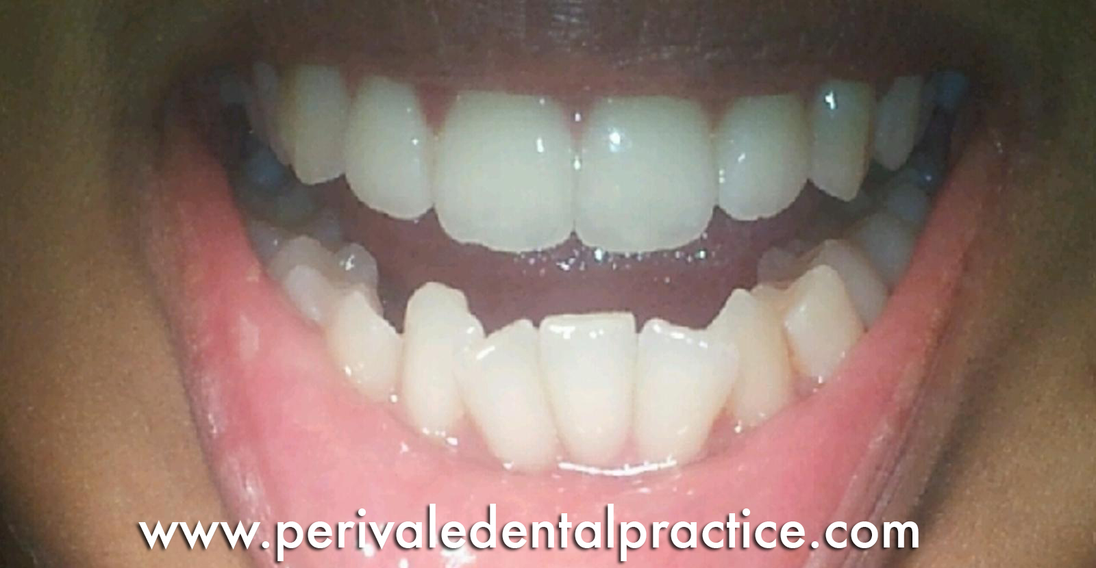 Before teeth straightening treatment