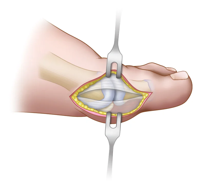 Foot Surgery for Operative Techniques in Orthopaedic Surgery, 2e , by Paul Tornetta, III MD, Sam W. Wiesel MD ©Wolters Kluwer Health