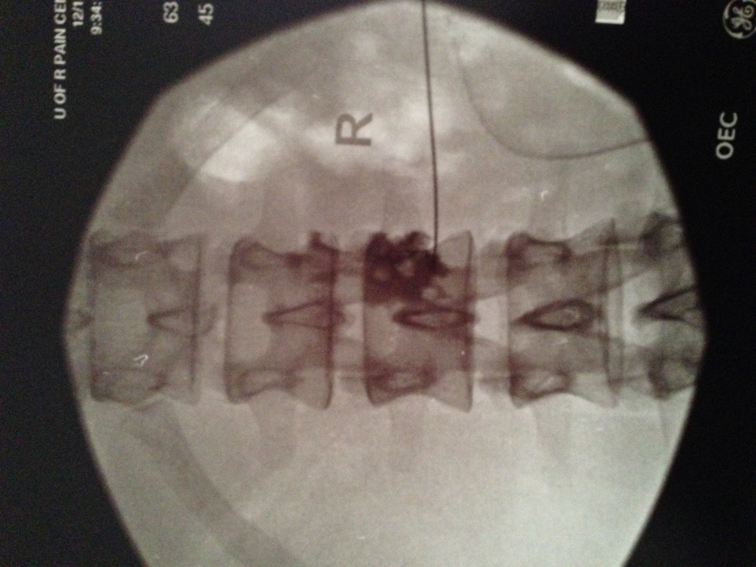 An x-ray from my first of four Lumbar Sympathetic Block--needle to my spine.