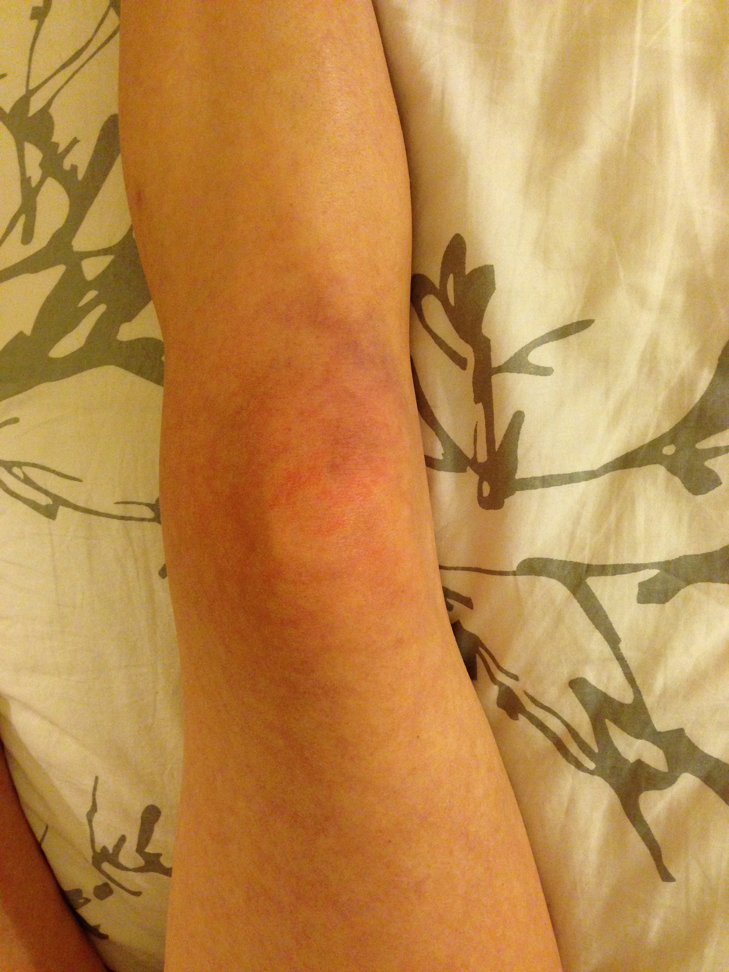 Different color changes and swelling were constant.