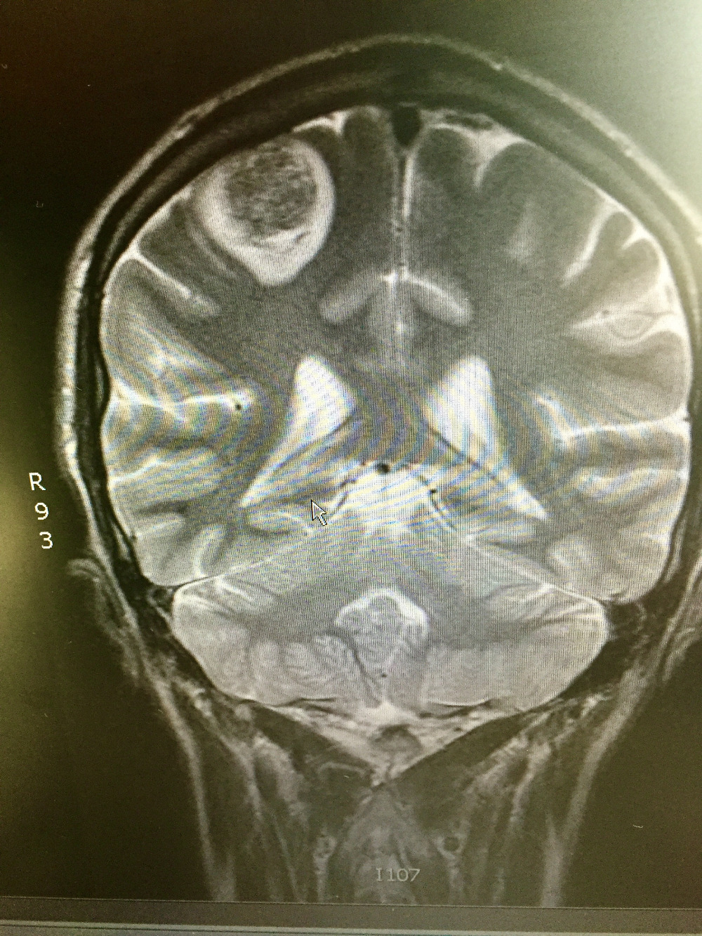 pre-opp MRI
