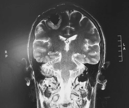 surgical resection, post-opp MRI
