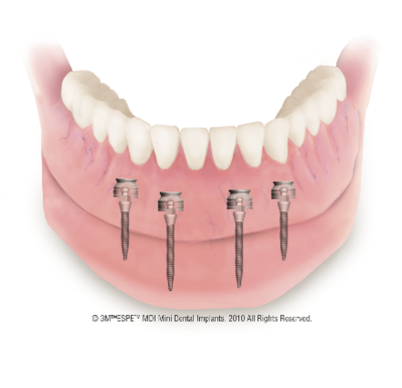 mdi_mandible_2-1.jpeg