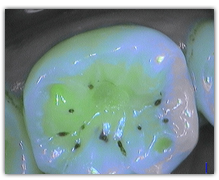 www.soprolife.com - Demineralization of the enamel present.