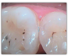 www.soprolife.com - Staining is present but cavity is not visible under white light.