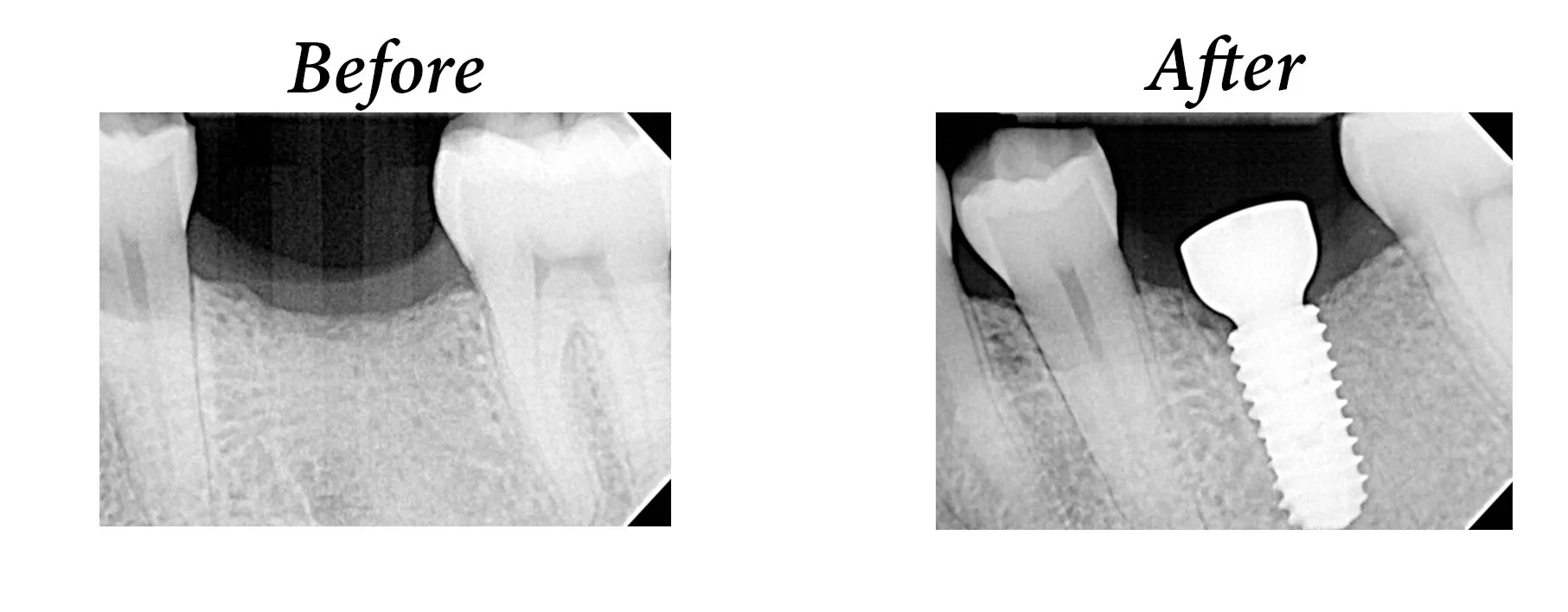 Implant.jpg