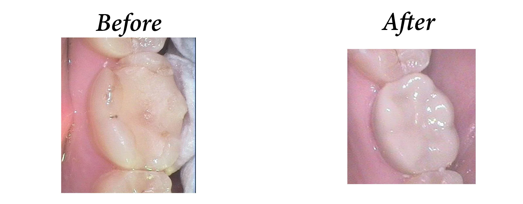 Zirconia Crown 2 copy copy.jpg
