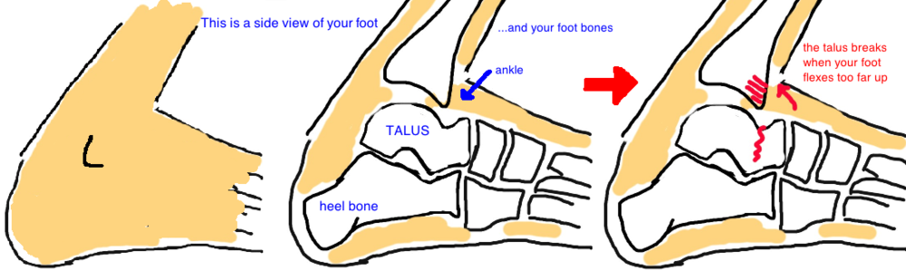 Talus fracture