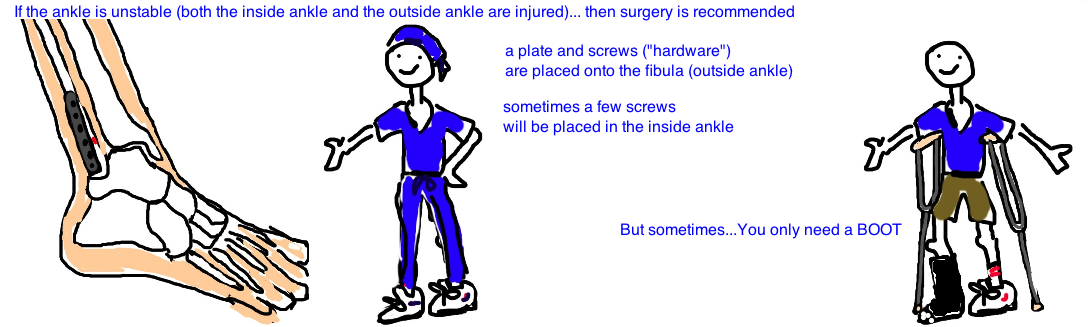 Broken Ankle (Distal Fibula Fracture) — Bone Talks