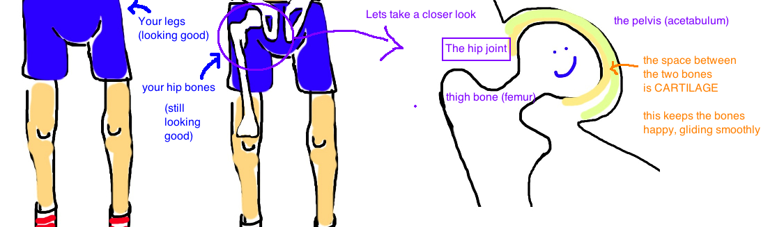 arthritis hip 1.jpg