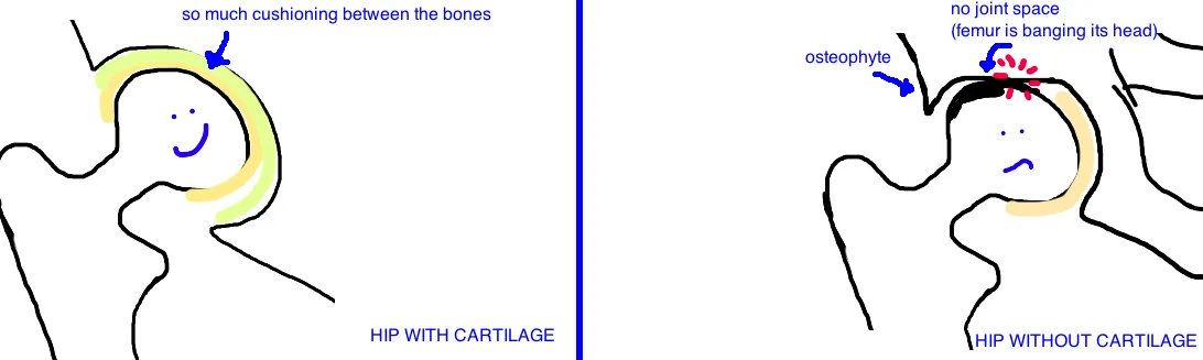 arthritis hip 3.jpg