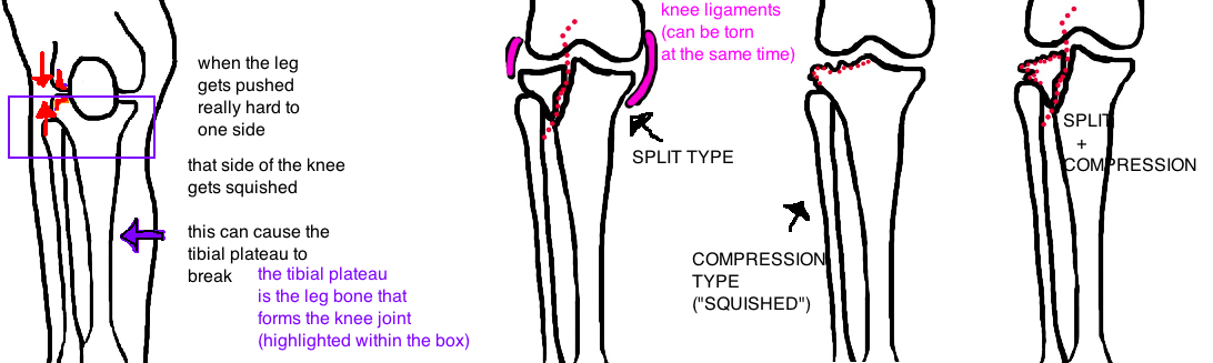 Broken Knee Tibial Plateau Fracture Bone Talks