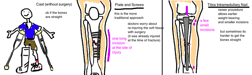 Broken Leg (Tibial Shaft Fracture) — Bone Talks