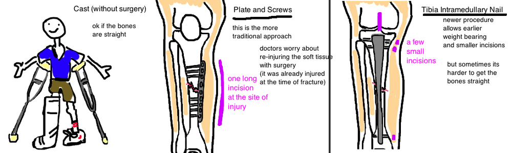 Broken Leg (Tibial Shaft Fracture) — Bone Talks Broken Leg (Tibial Shaft Fracture) — Bone Talks