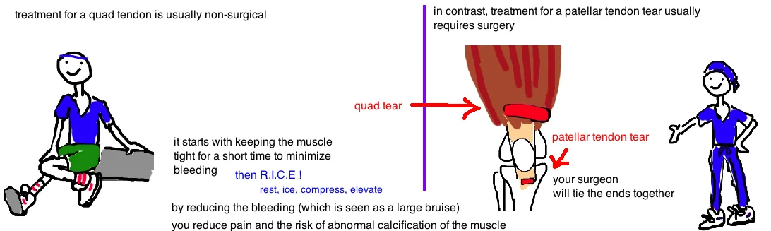 Quad Tear Bone Talks