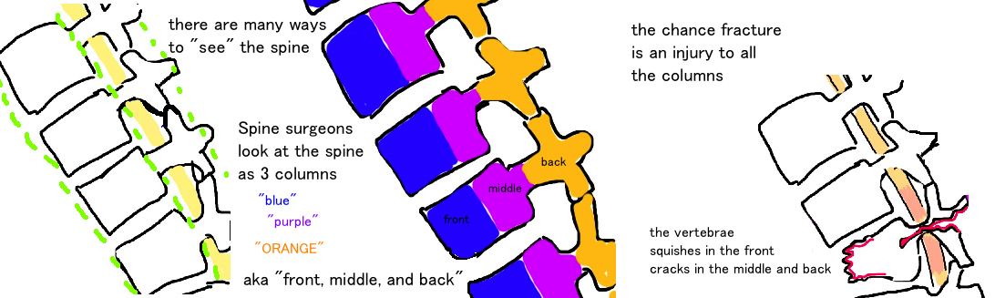 three column spine injury, chance fracture, broken spine, flexion-distraction injury of the spine