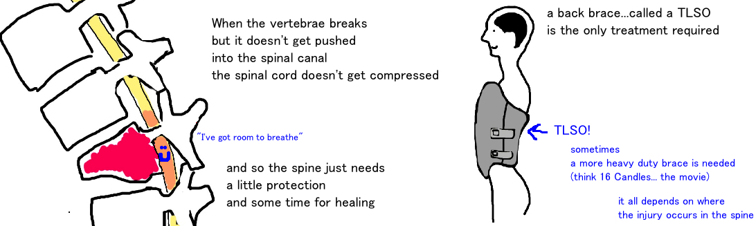 Spine - Burst Fracture — Bone Talks