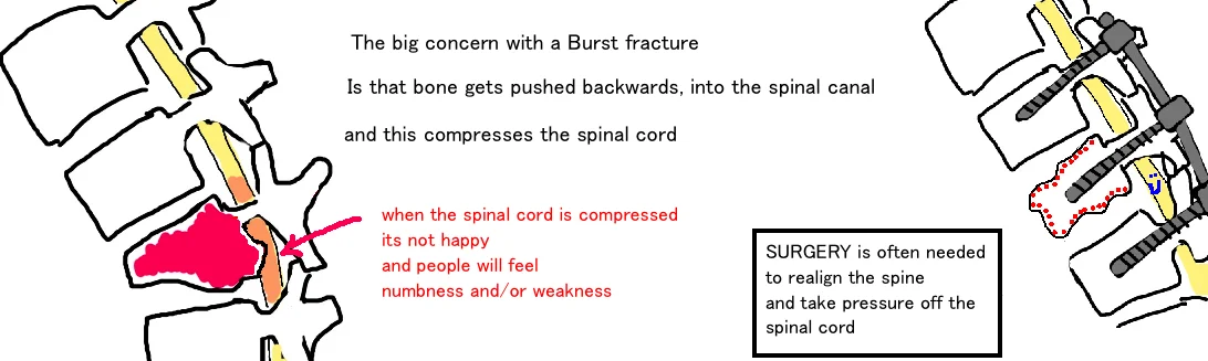 Spine - Burst Fracture — Bone Talks