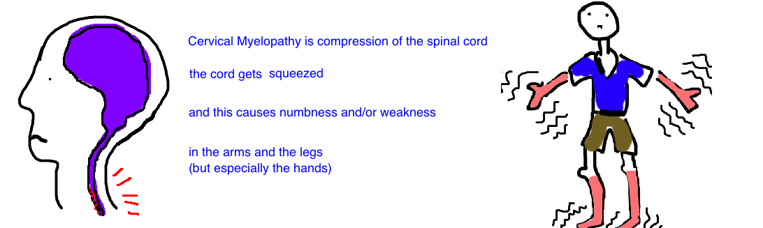 Spine Injury Central Cord Syndrome Bone Talks