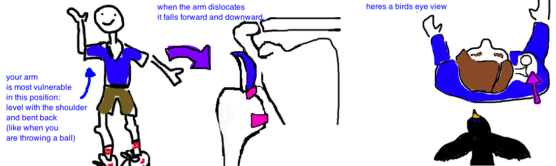 Shoulder Dislocation — Bone Talks