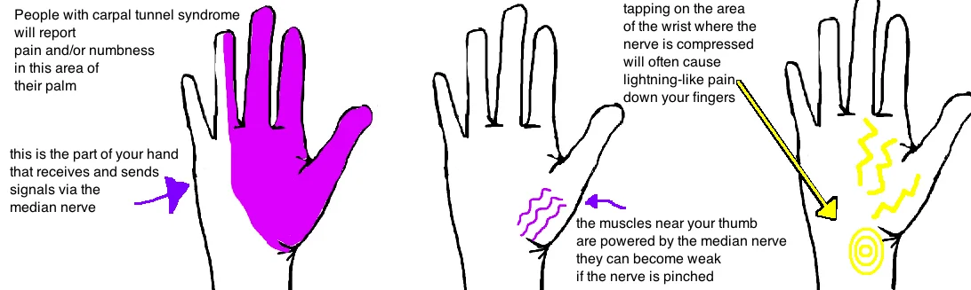 Carpal Tunnel Syndrome Bone Talks