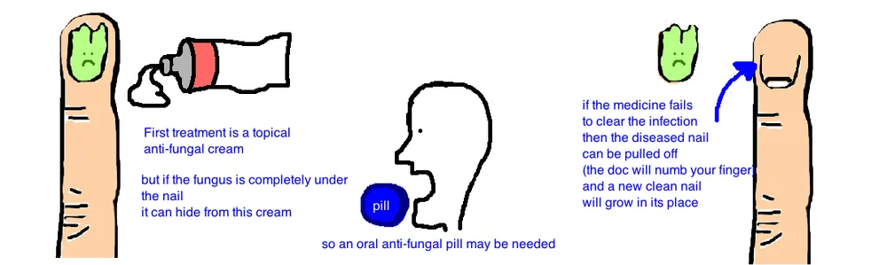 Nailbed And Finger Infections Bone Talks