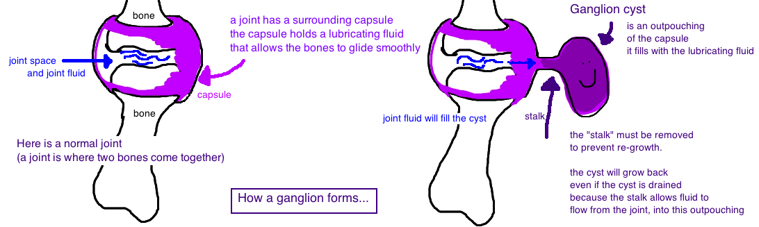 Download Ganglion Cyst Book Slam Pictures