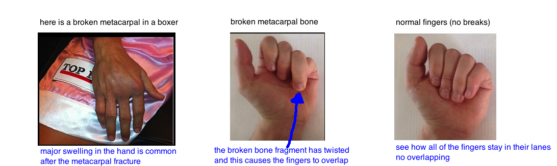 Broken Hand (Metacarpal Fracture) — Bone Talks