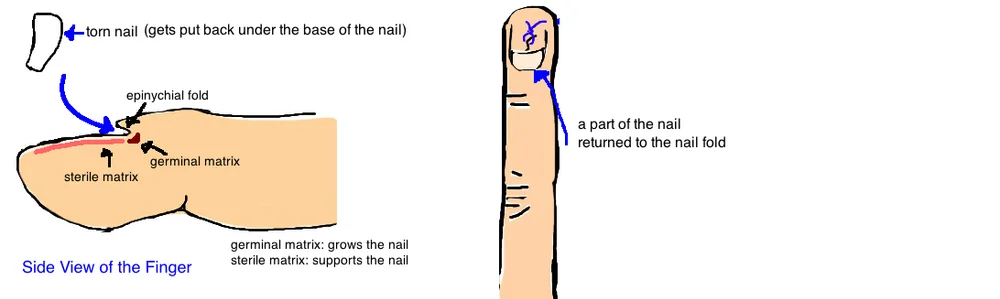 Nailbed Injury Broken Finger Tip Bone Talks