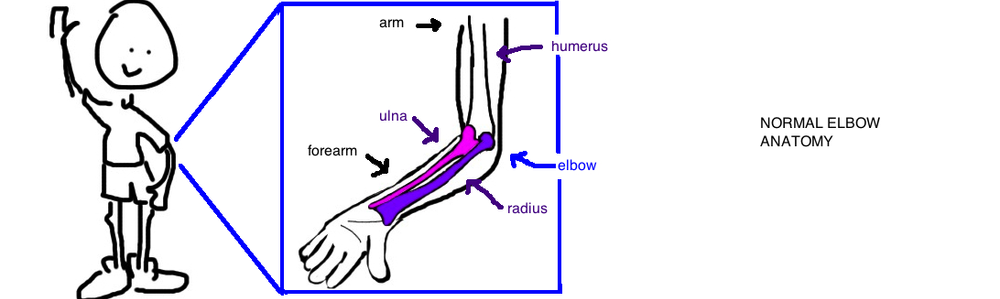Kids Broken Forearm Both Bone Forearm Fracture Bone Talks