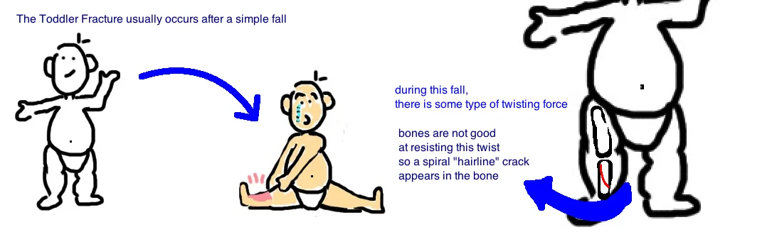 Kids Toddler Fracture Bone Talks