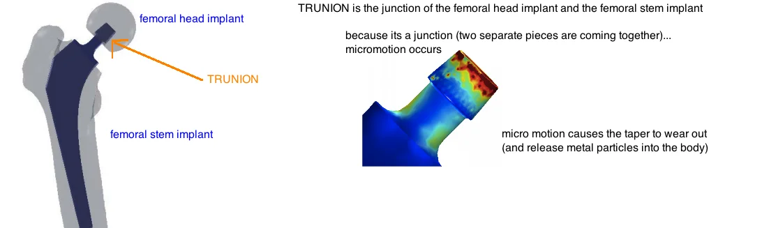 Trunionosis in THA fretting corrosion at the head neck junction